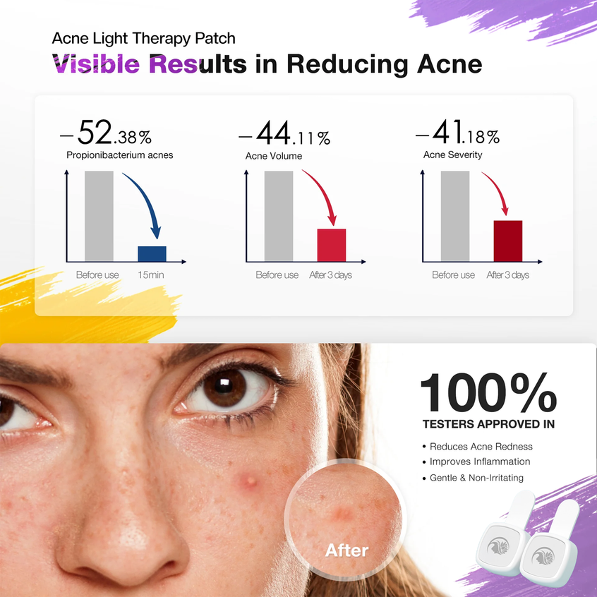 Acne light therapy patches, showing before and after effects on a person's skin.
